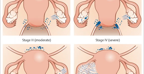 Does endometriosis have stages?