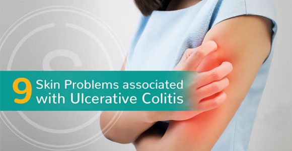9 Skin Problems associated with Ulcerative Colitis | SMILES Bangalore