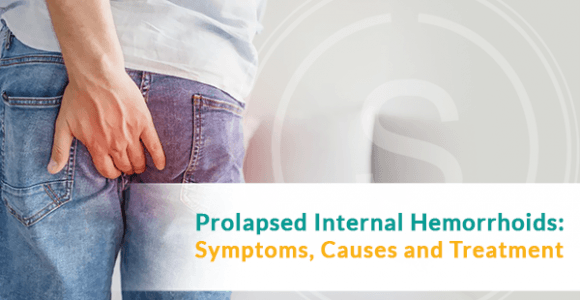 Prolapsed Internal Hemorrhoids: Symptoms, Causes, and Treatment