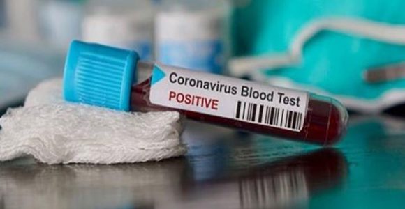 You Tested Positive for COVID-19. What Next? | SMILES Bangalore