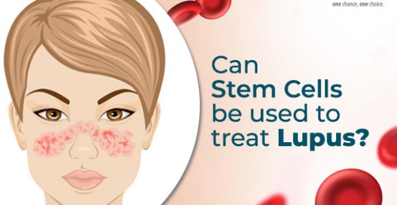 Can Stem Cells be Used to Treat Lupus?