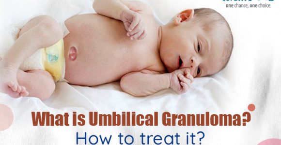 What Is Umbilical Granuloma? How To Treat It?