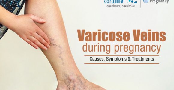 Varicose Veins During Pregnancy – Causes, Symptoms & Treatments